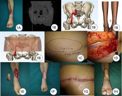 Clinical application of digital technology in the reconstruction of soft tissue defects of the lower extremity with free superficial circumflex iliac artery flap